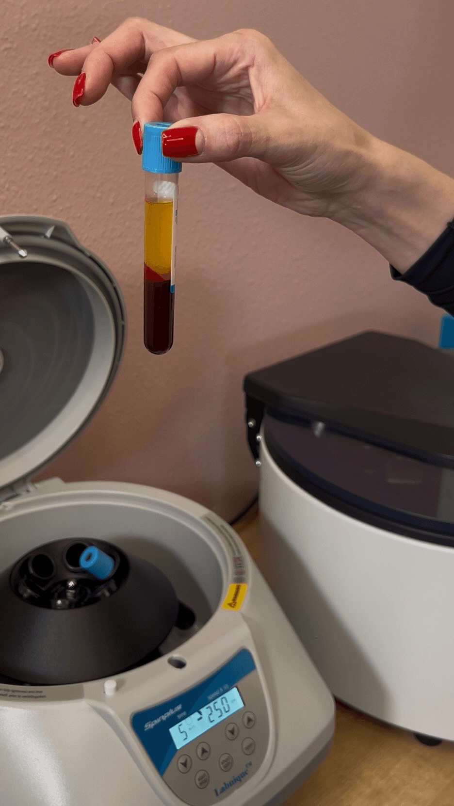PRP centrifuge with platelet-rich plasma prepared for treatment