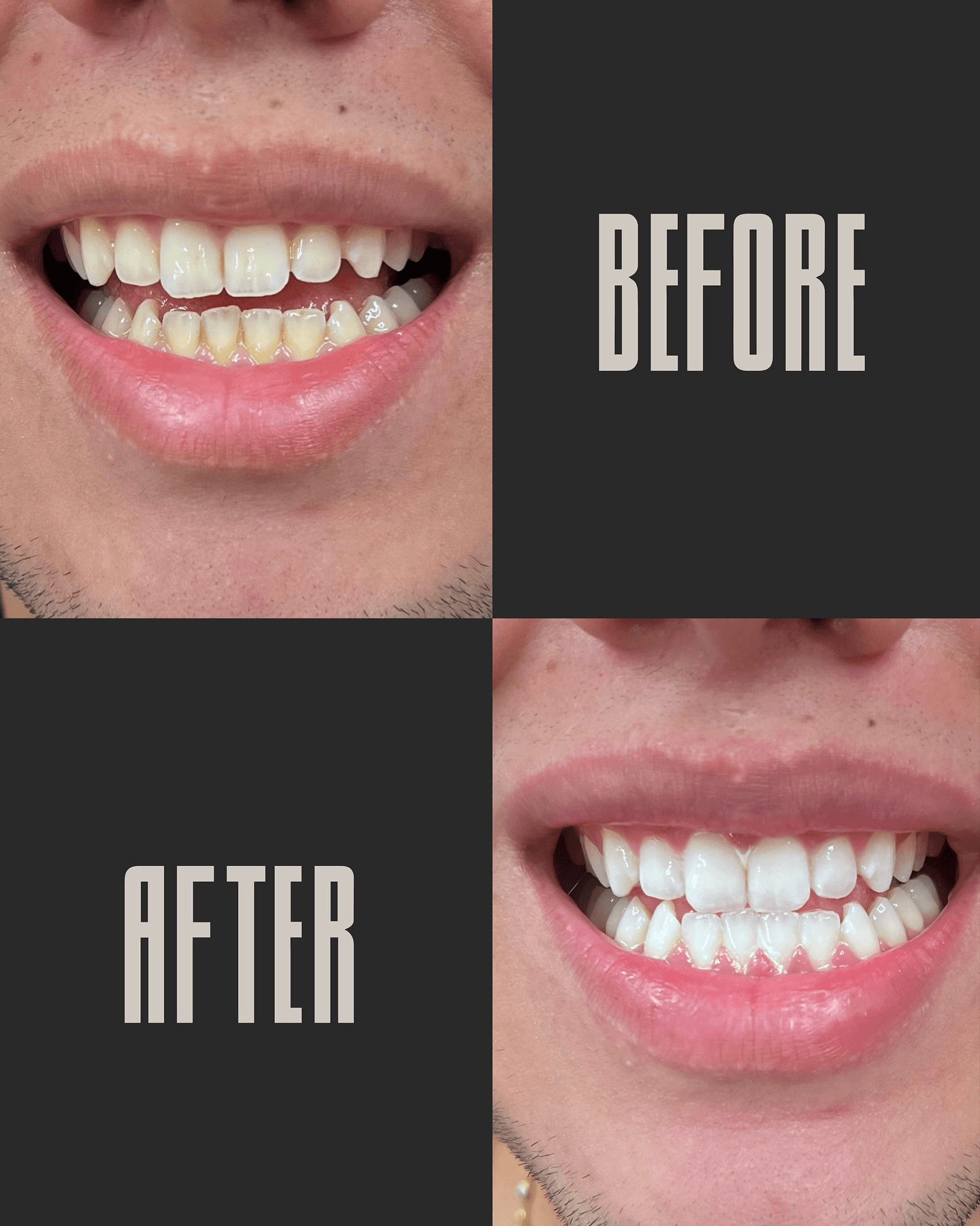 Before and after professional teeth whitening results